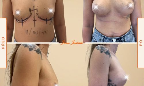 přirozené zvětšení prsou anatomickým silikonovým implantátem